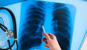 В Краматорске выросло число заболевших туберкулезом