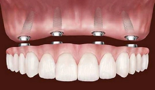 Протезирование зубов на имплантах: в чём особенность данного метода восстановления зубов