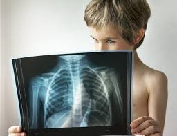 В Покровске у восьмиклассника обнаружили туберкулез
