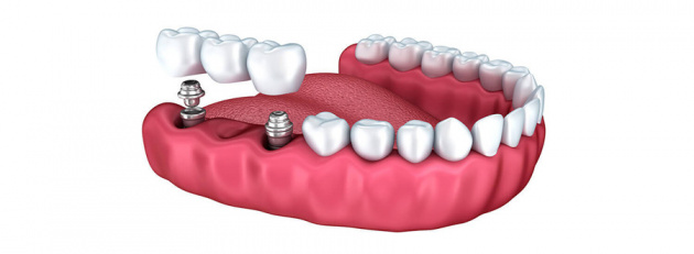 Протезирование зубов на имплантах