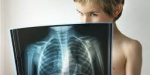 В Покровске у восьмиклассника обнаружили туберкулез